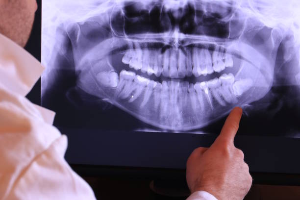 Best Emergency Dentist for Lost Fillings or Crowns in Butler Beach, FL
